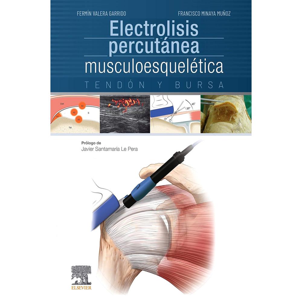 Foto 2 pulgar | Electrolisis Percutánea Musculoesquelética. Tendón Y Bursa