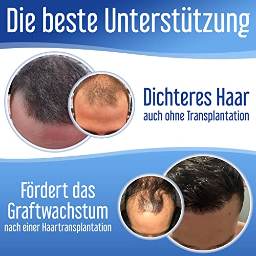 Foto 3 pulgar | Suplemento Xpecia Para Hombres Contra La Caída Del Cabello 60 Tabletas - Venta Internacional.