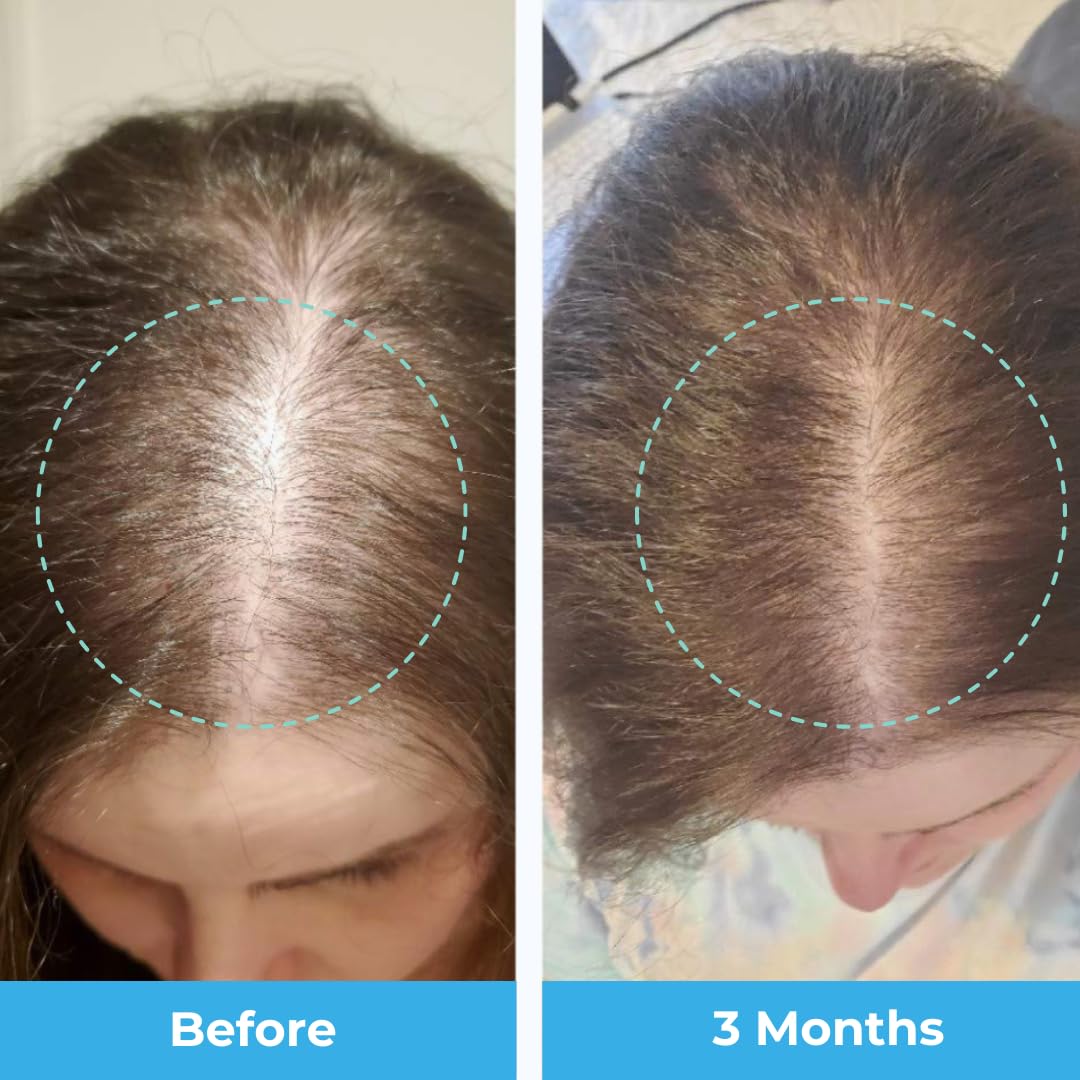 Foto 7 pulgar | Gomitas De Maracuyá Posparto Con Vitaminas Para La Pérdida Del Cabello Baby Blues - Venta Internacional.