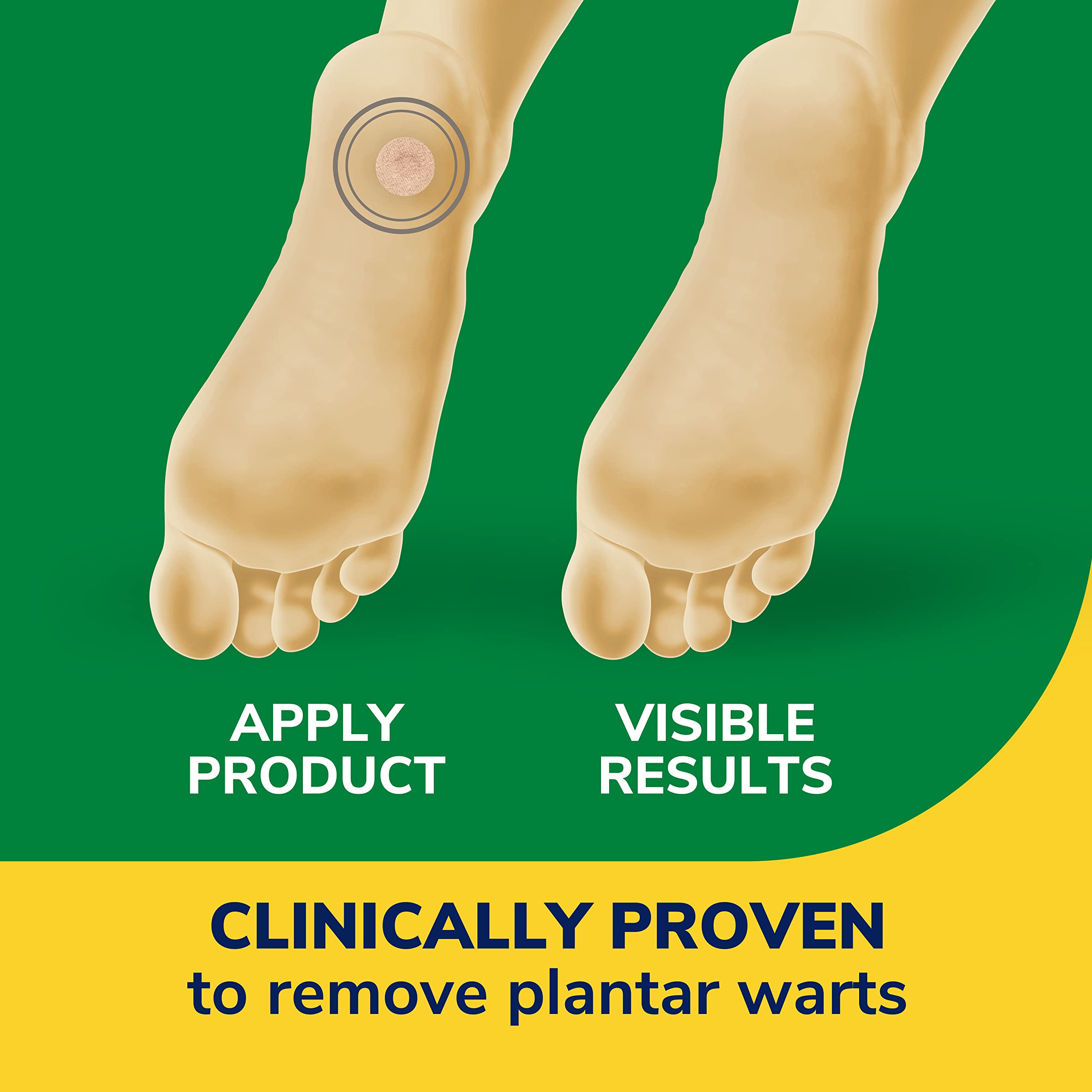 Foto 4 pulgar | Eliminador De Verrugas Dr. Scholl's Clear Away Plantar 24 Tratamientos - Venta Internacional.