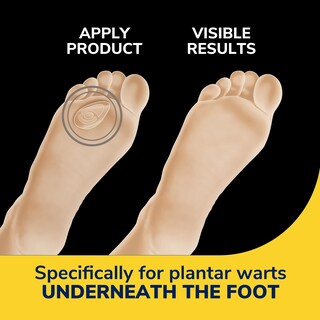 Foto 2 | Plantilla Dr. Scholl's Eliminador de Verrugas - Venta Internacional