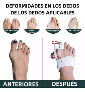 Foto 4 | Corrector De Juanetes Sistema Quick-fit: Alivio Y Ajuste De Angulos (talla Universal)