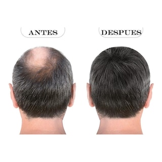 Foto 7 | Kit Sistema Capilar Noxidil Shampoo + Loción + Roller Pelo