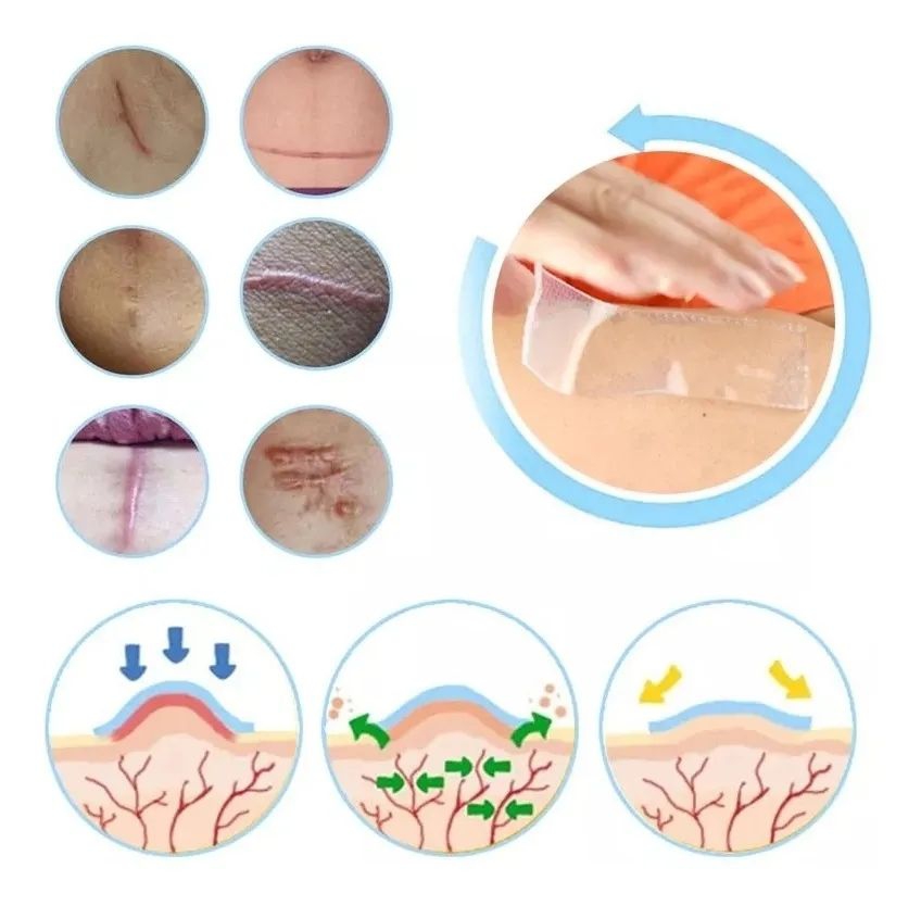 Foto 8 pulgar | Parche de Silicona para Cicatrices Hipertróficas y Queloides - Venta Internacional