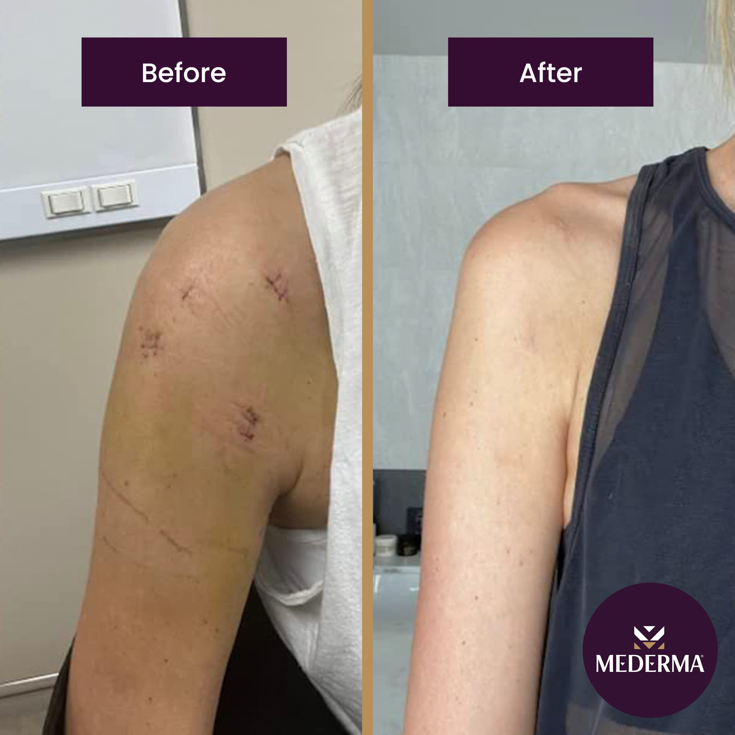 Foto 8 pulgar | El Gel Para Cicatrices Mederma Advanced De 50 G Trata Las Cicatrices Antiguas Y Nuevas - Venta Internacional.