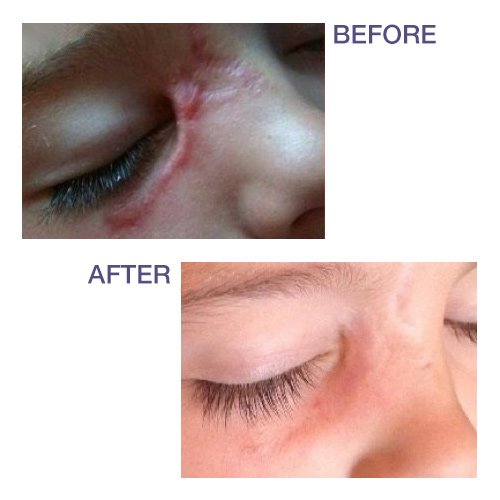 Foto 3 | Barra de Tratamiento de Cicatrices Biodermis Pro-sil Spf 15 4,25 g - Venta Internacional