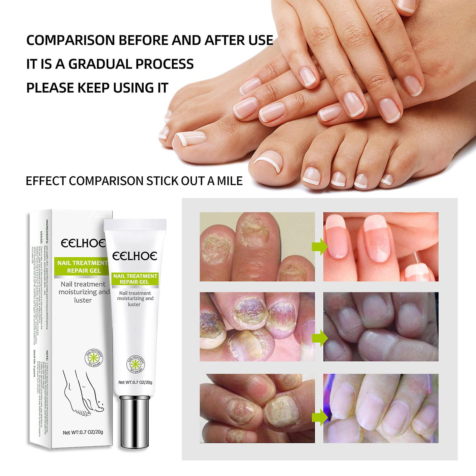 Foto 5 pulgar | Gel Reparador De Uñas Huoguo 20 G Para Uñas Infectadas O Agrietadas - Venta Internacional.