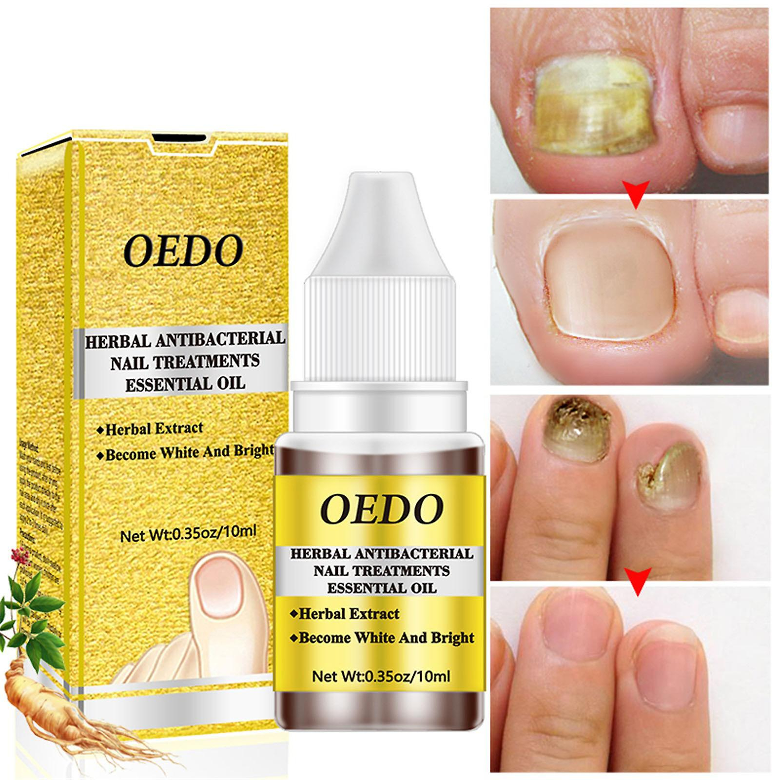 Foto 2 | El Aceite Esencial Para El Cuidado De Las Uñas Huoguo Previene El Crecimiento De Hongos  10 Ml - Venta Internacional.