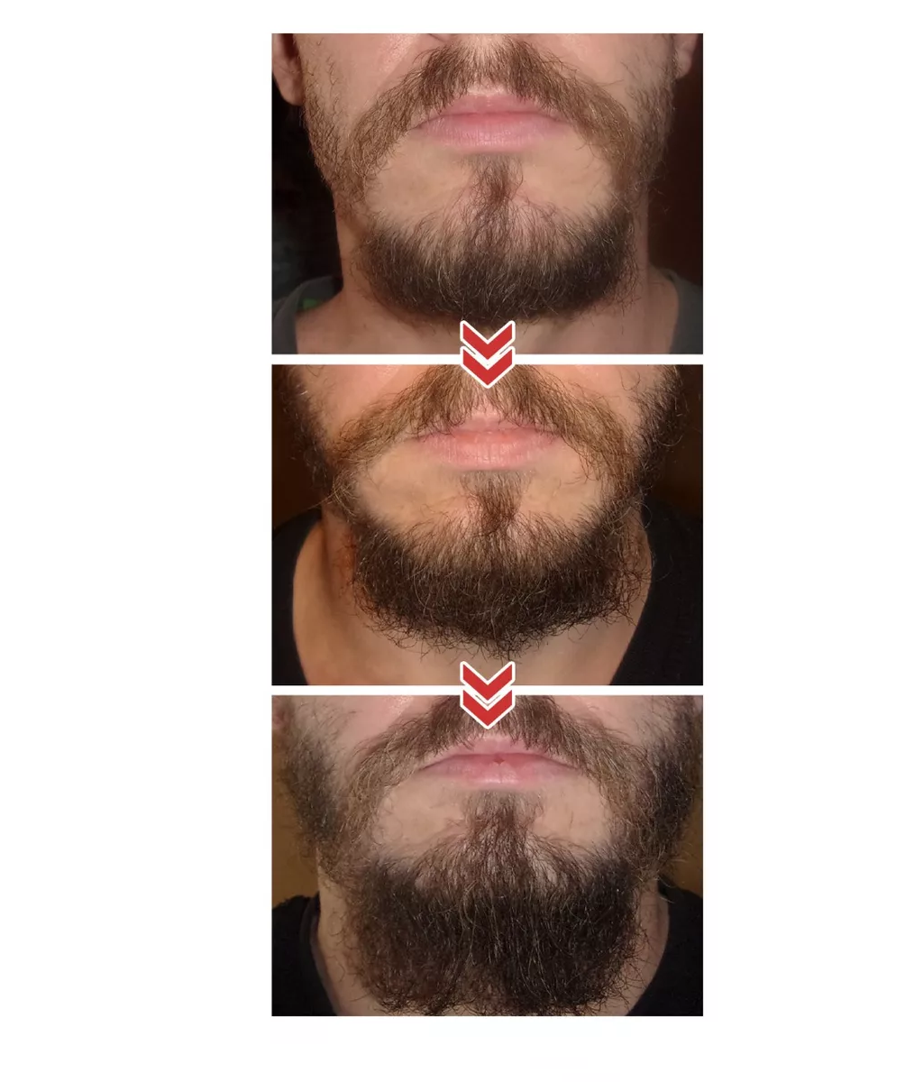 Foto 6 pulgar | Derma Roller Belug 0.5 Mm Para Barba Y Facial Cabello Negr