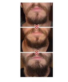 Foto 5 | Derma Roller 0.5 mm para Barba y Facial Cabello Negro