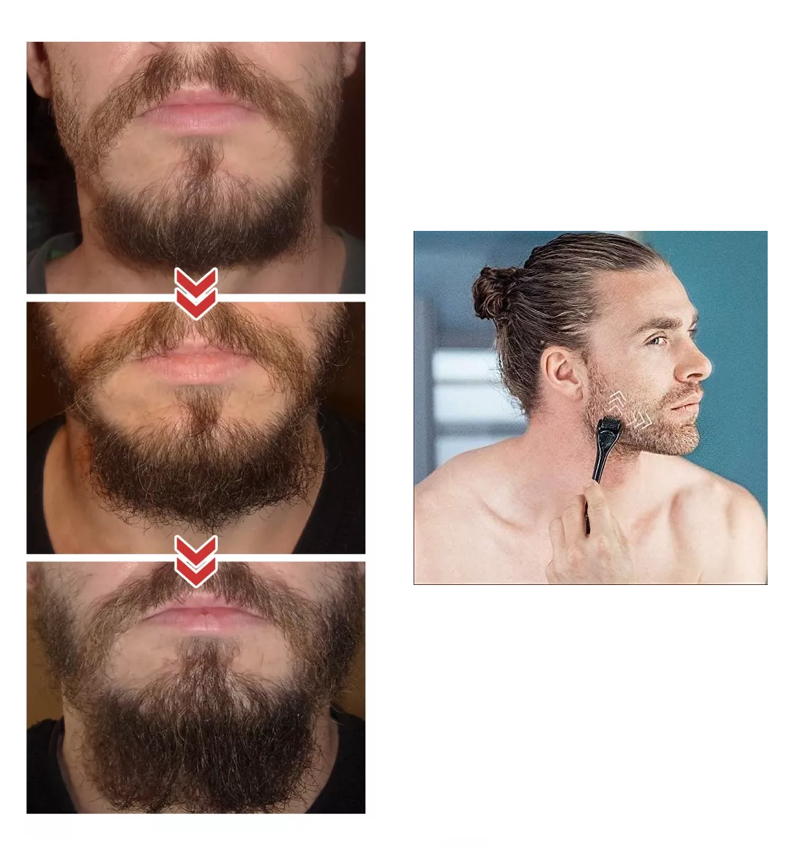 Foto 4 | Derma Roller 0.5 Mm Para Barba, Facial Y Cabello, Negro