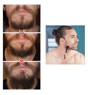 Foto 4 | Derma Roller 0.5 Mm Para Barba, Facial Y Cabello, Negro