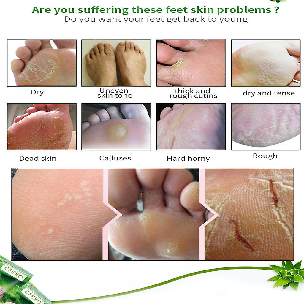 Foto 5 pulgar | Mascarilla Exfoliante Para Pies Huoguo  Eliminadora De Piel Muerta Áspera  50 Ml - Venta Internacional.