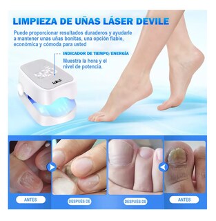 Foto 5 | Laser Para Quitar Hongos De Las Uñas Elimina Onicomicosis Blanco