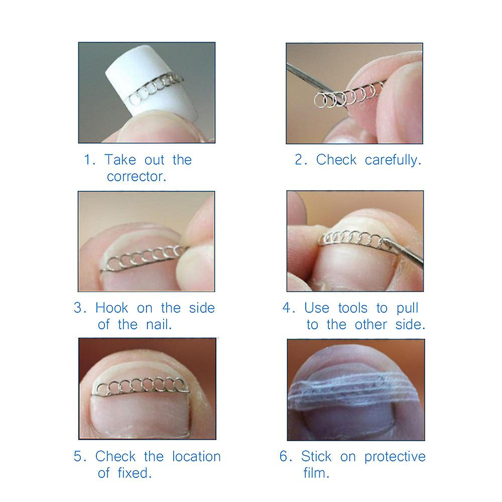 Foto 4 pulgar | Fijador De Alambre Corrector De Uñas Para Pedicura  6 Pares  Huoguo - Venta Internacional.