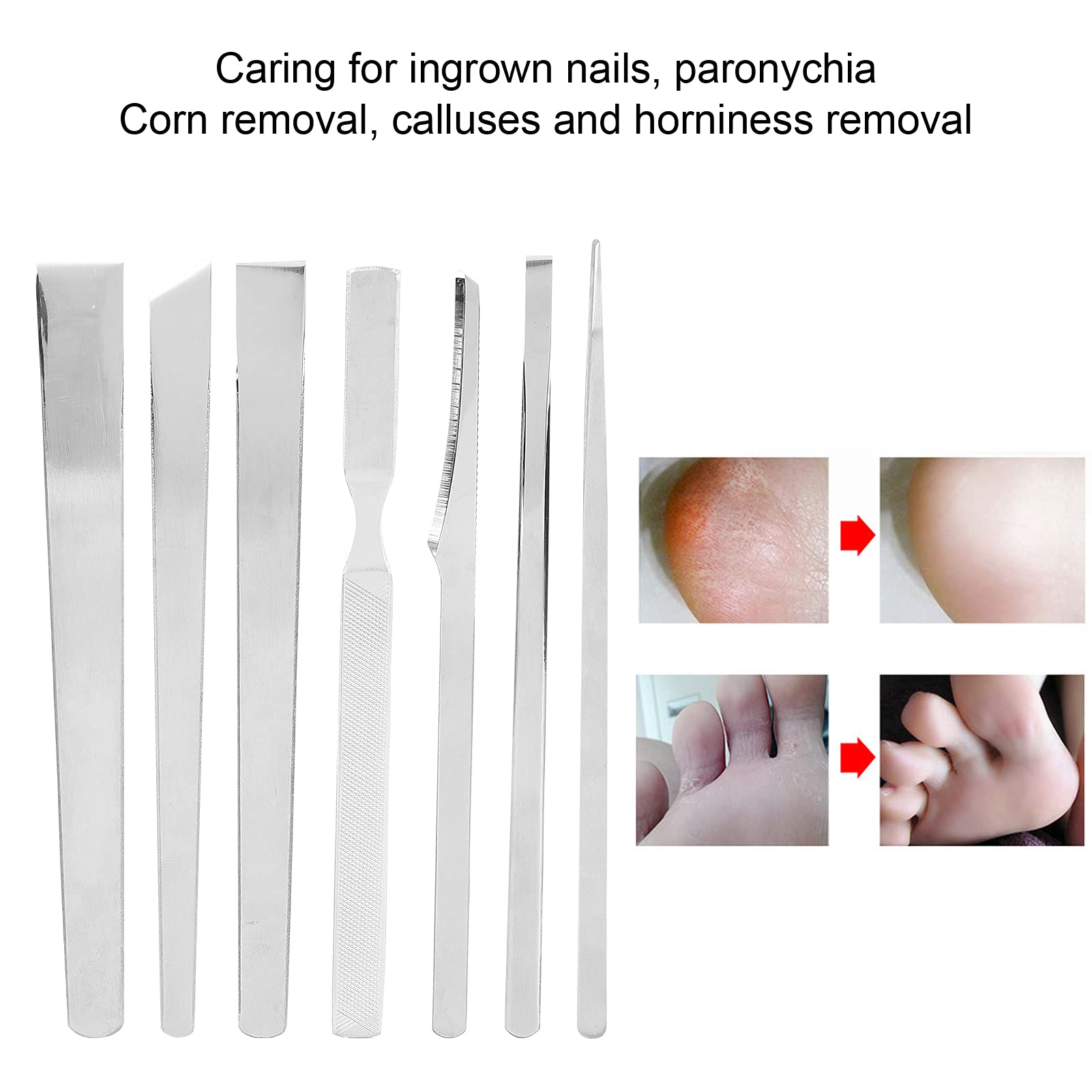 Foto 3 pulgar | Juego De Cuchillos De Pedicura Dioche Household Para Eliminar Uñas Encarnadas - Venta Internacional.