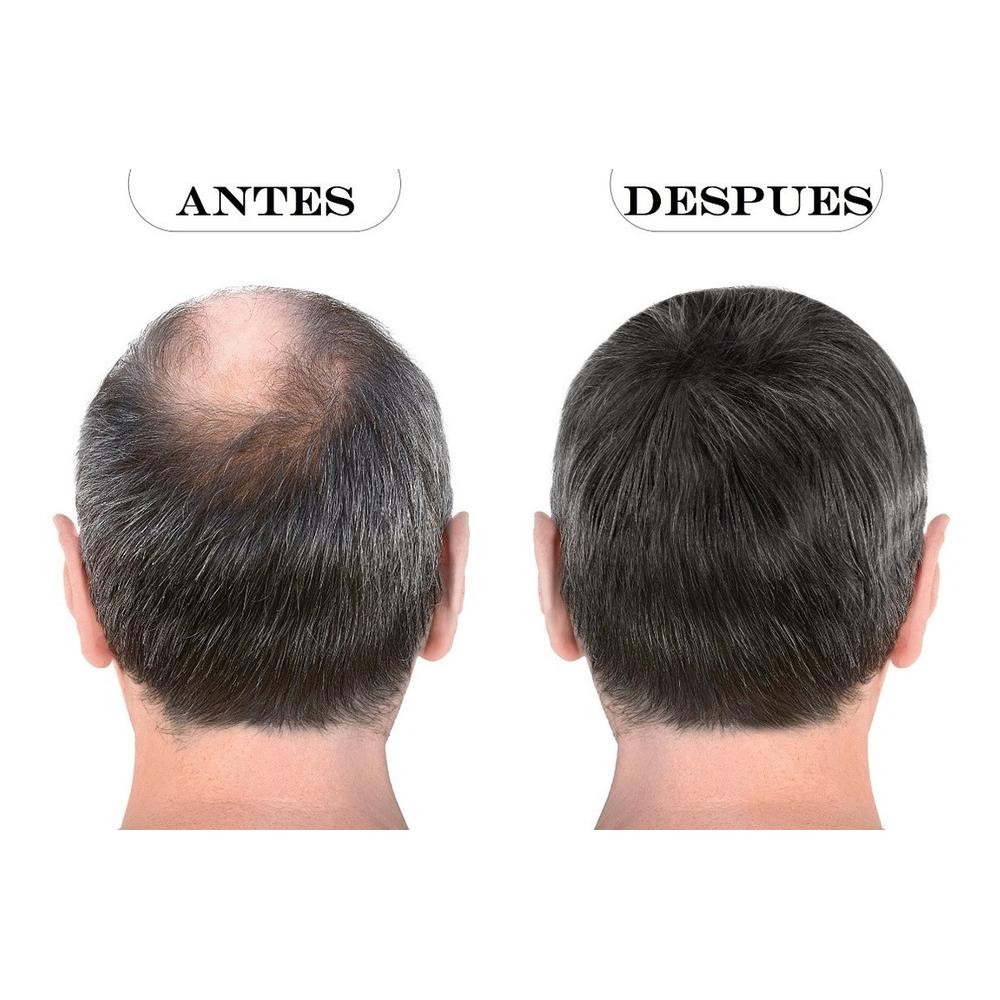 Foto 6 pulgar | Kit X 2 Crecimiento Regenera Capilar The Shaving Co Noxidil