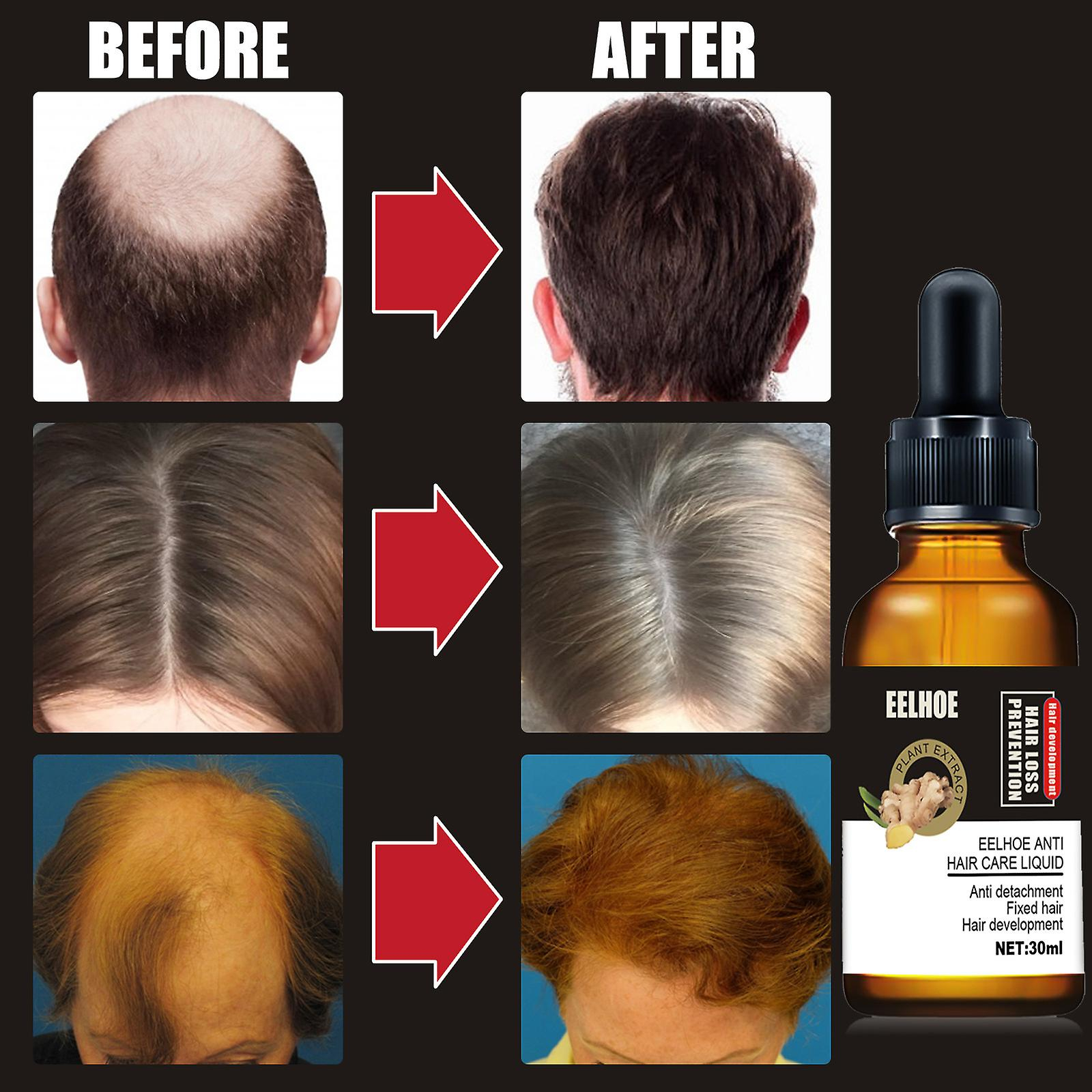 Foto 4 pulgar | Aceite Esencial Para El Crecimiento Del Cabello Huoguo Plant Anticaída  30 Ml - Venta Internacional.