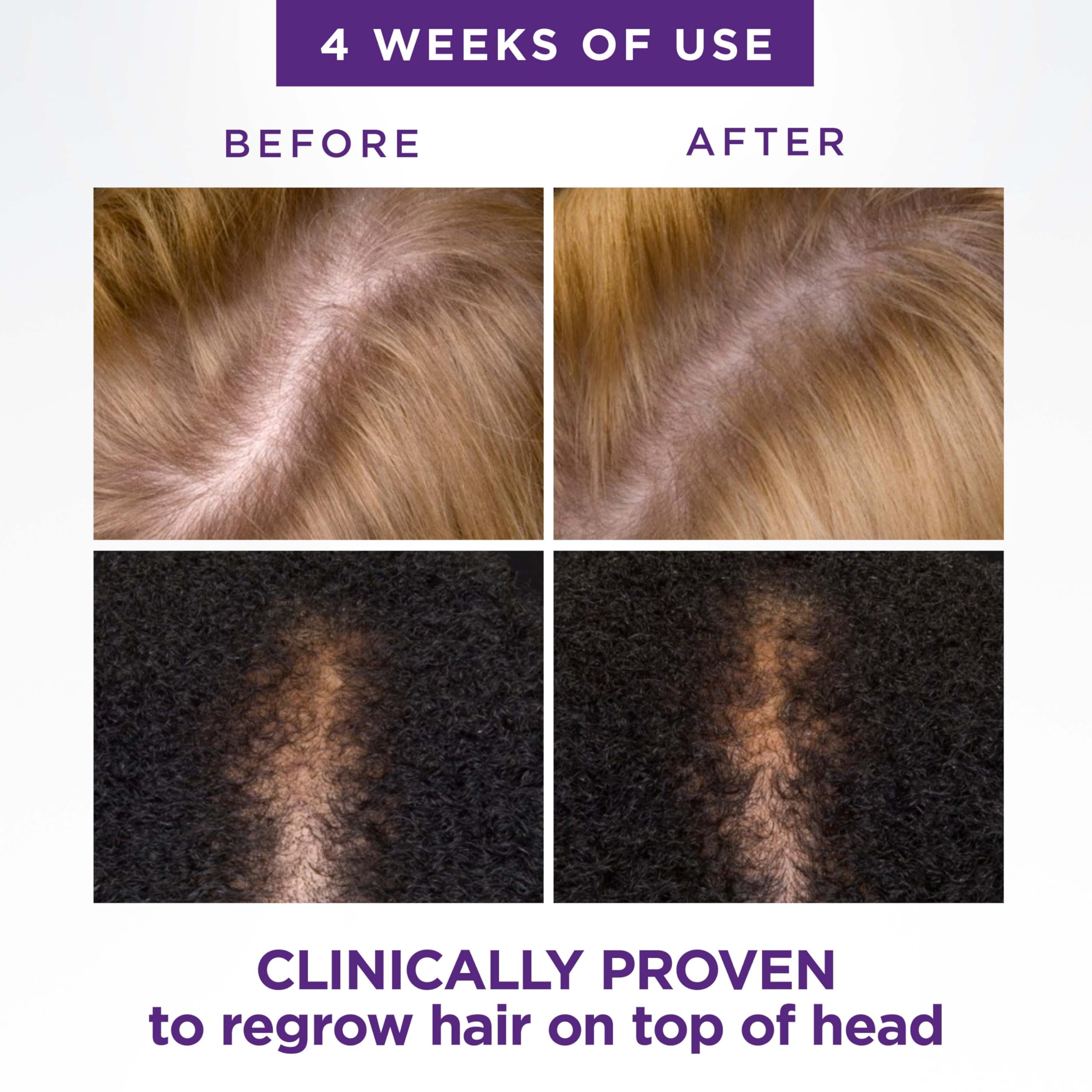 Foto 7 pulgar | Tratamiento Para El Crecimiento Del Cabello, Cabeza Y Hombros, Cuero Cabelludo X 2% Minoxidil - Venta Internacional.