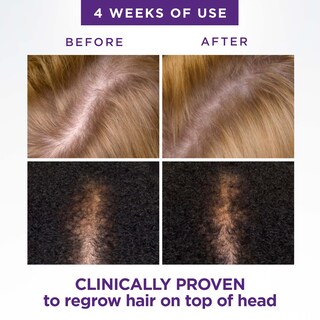 Foto 6 | Tratamiento Para El Crecimiento Del Cabello, Cabeza Y Hombros, Cuero Cabelludo X 2% Minoxidil - Venta Internacional.