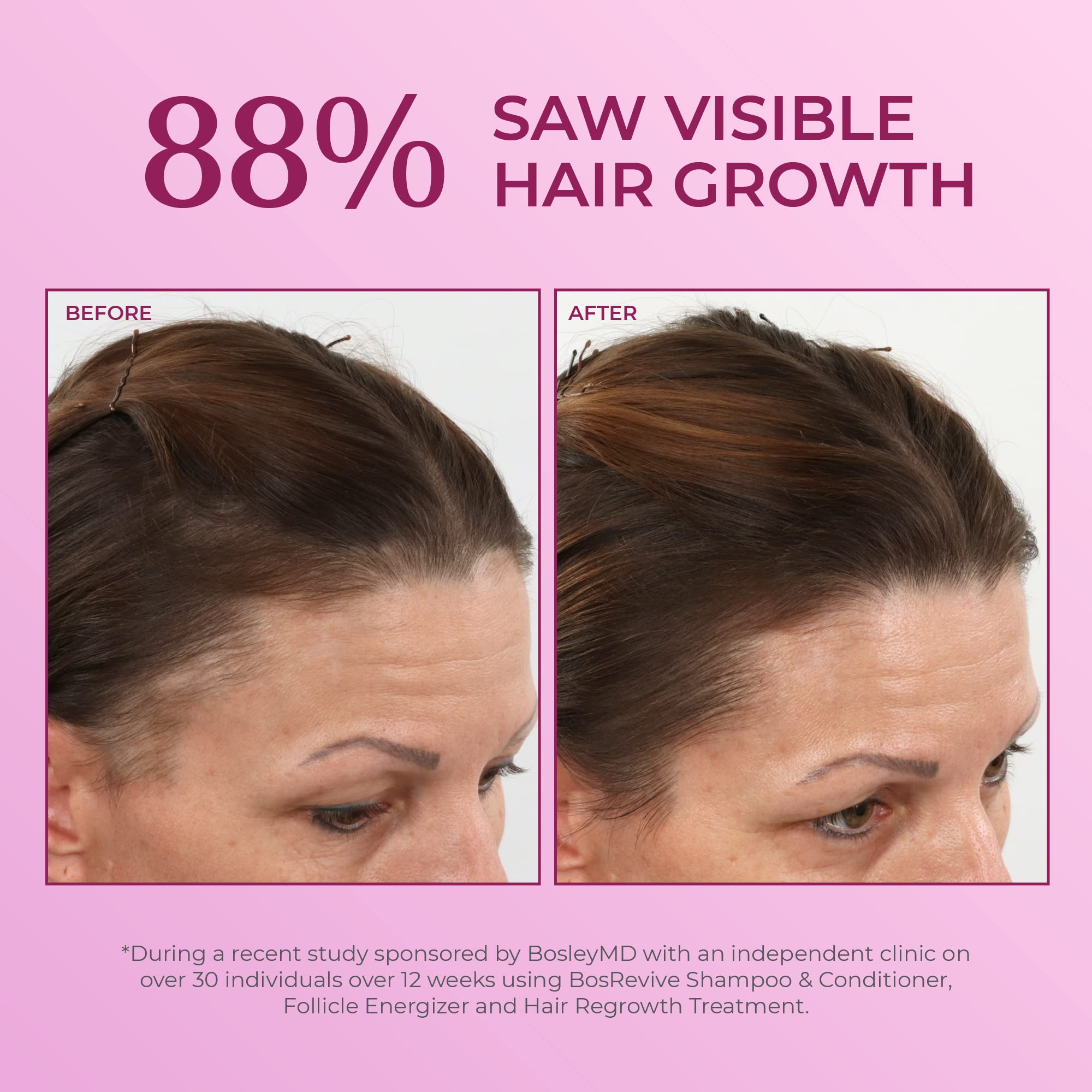 Foto 4 pulgar | Tratamiento Para El Crecimiento Del Cabello Bosleymd Minoxidil Para Mujer, 60 Ml, 2 - Venta Internacional.