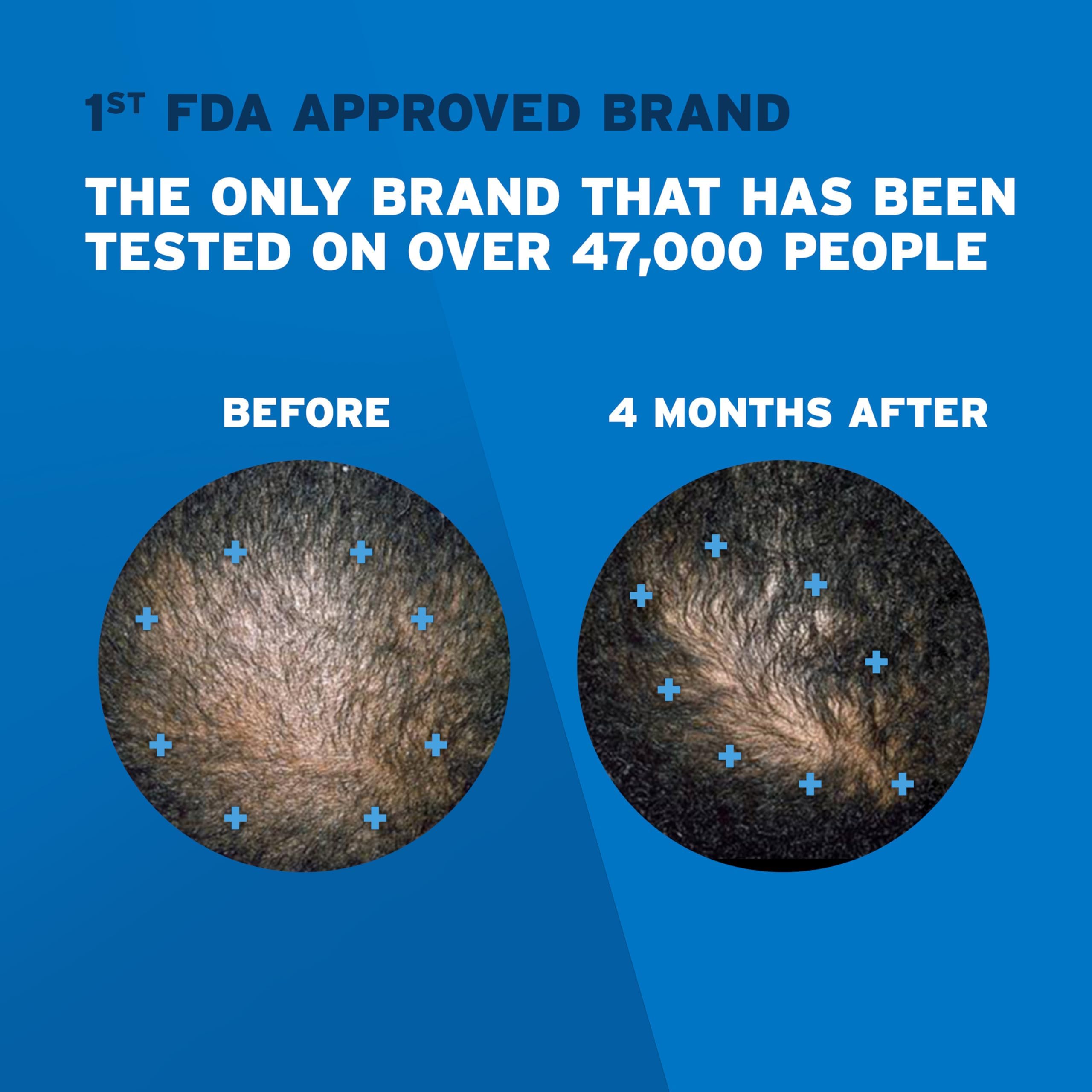 Foto 5 pulgar | Espuma De Tratamiento Para El Crecimiento Del Cabello Rogaine 5% Minoxidil Men - Venta Internacional.