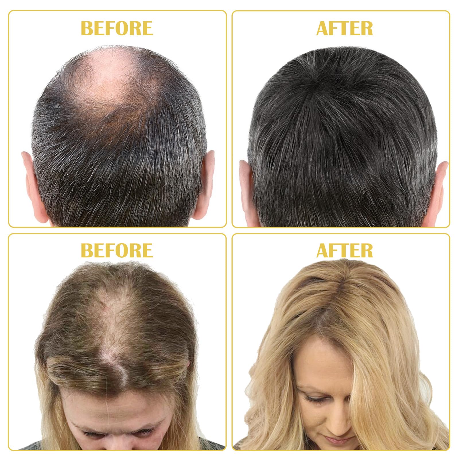 Foto 8 pulgar | Kit Para El Crecimiento Del Cabello Con Minoxidil 5% Para Hombres Y Mujeres Y Suero De Biotina - Venta Internacional.