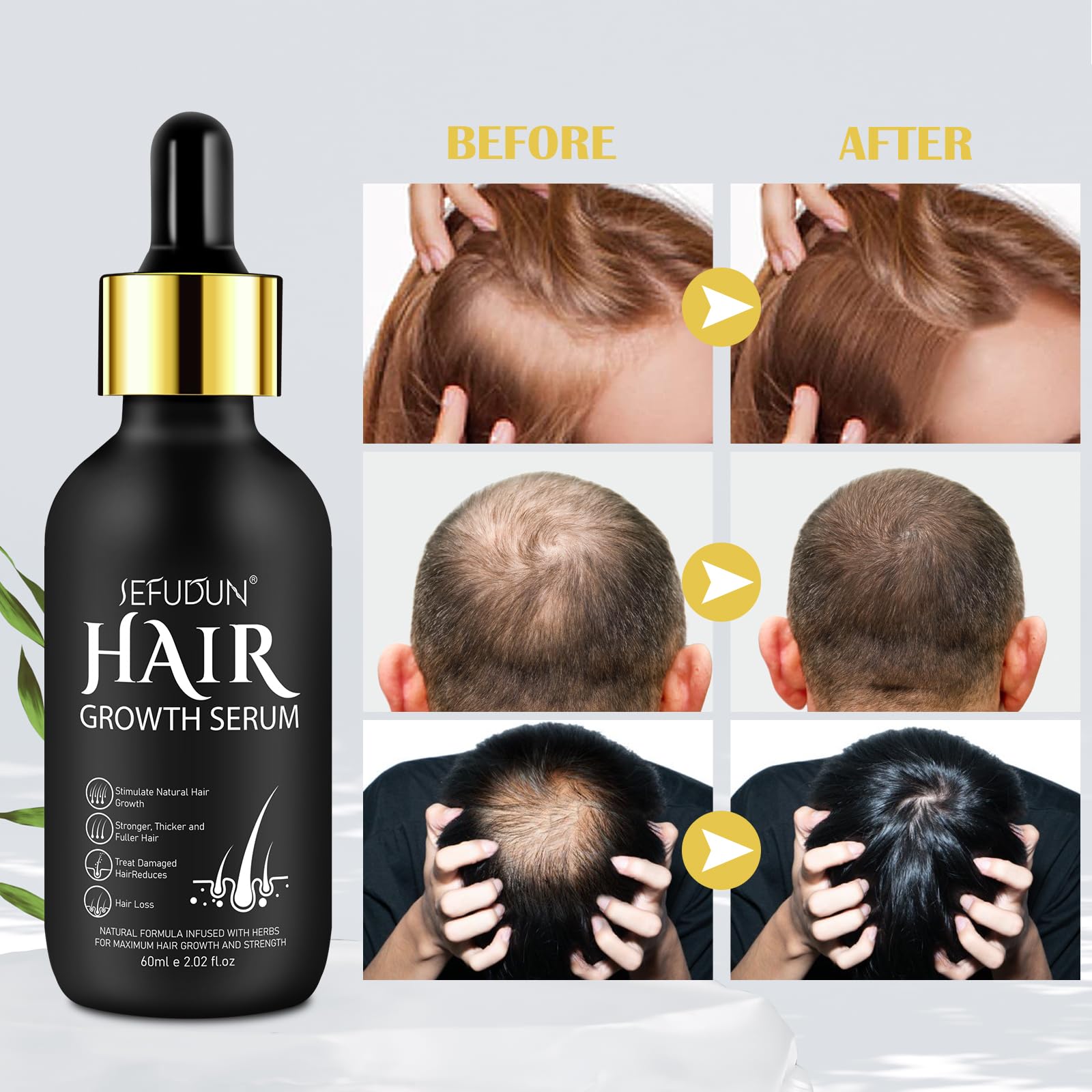 Foto 6 pulgar | Aceite Para El Crecimiento Del Cabello Minoxidil 5% Para Hombres Y Mujeres, 60 Ml - Venta Internacional.