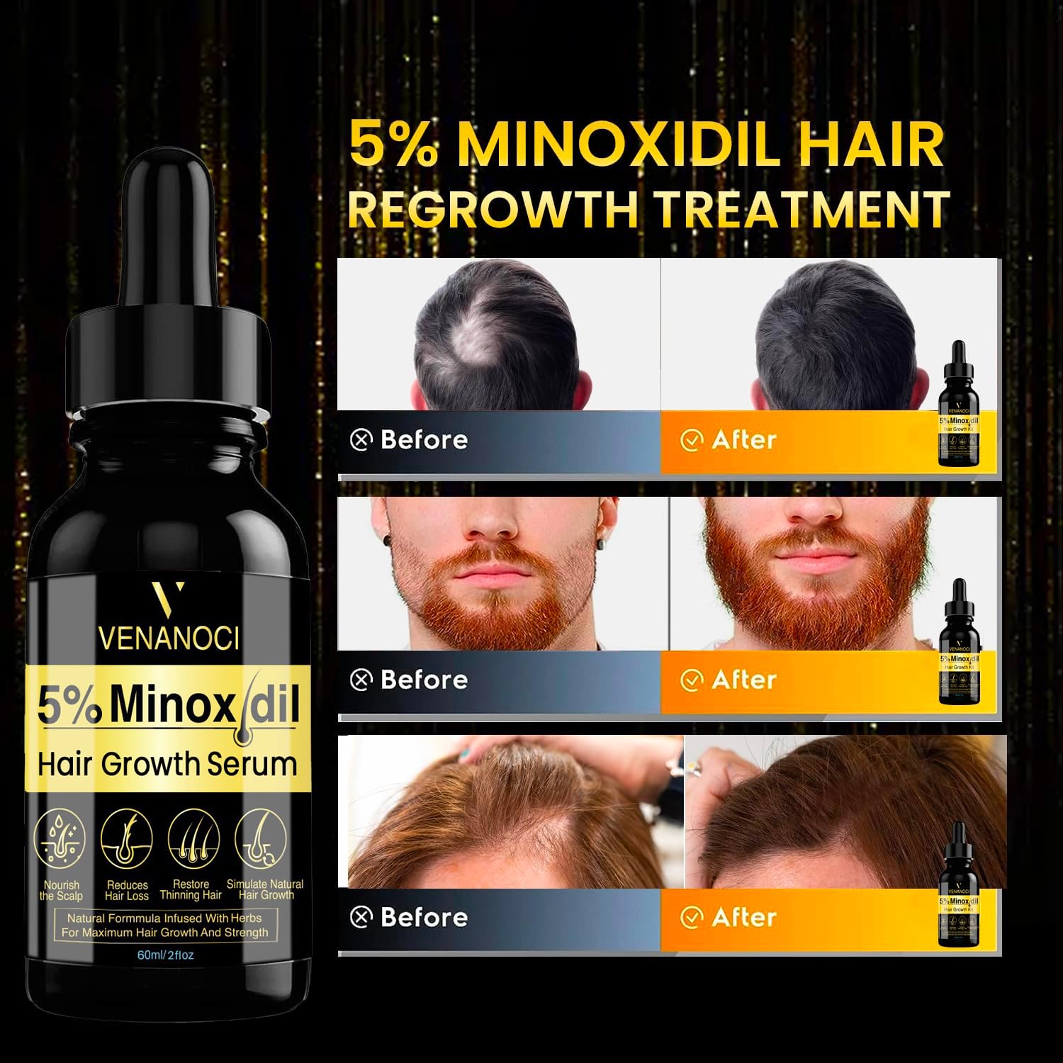 Foto 3 pulgar | Aceite para Crecimiento de Cabello Venanoci 5% Minoxidil Unisex - Venta Internacional