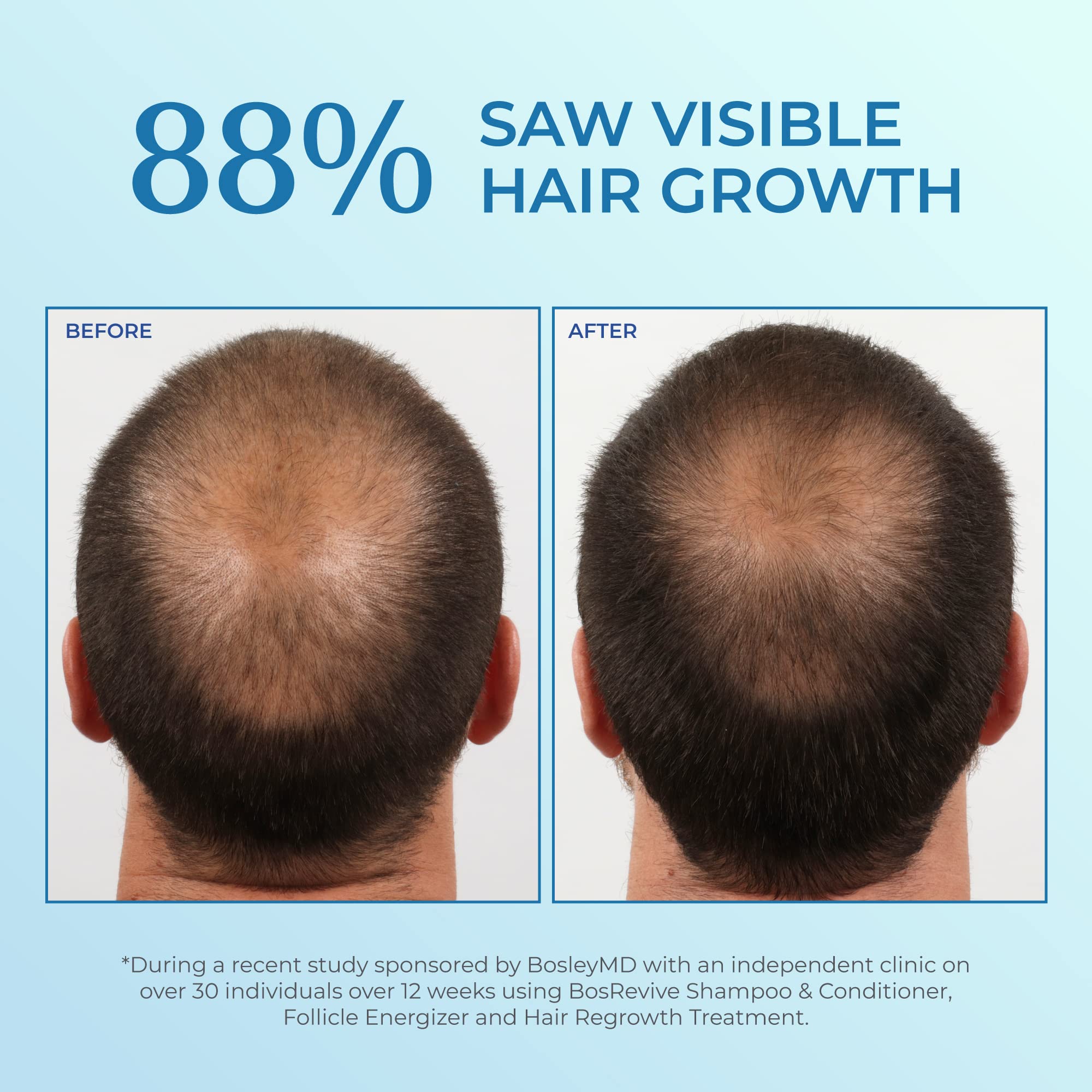 Foto 4 pulgar | Tratamiento Adelgazante Bosleymd Minoxidil Foam 5% 60 Ml 1 Mes - Venta Internacional.