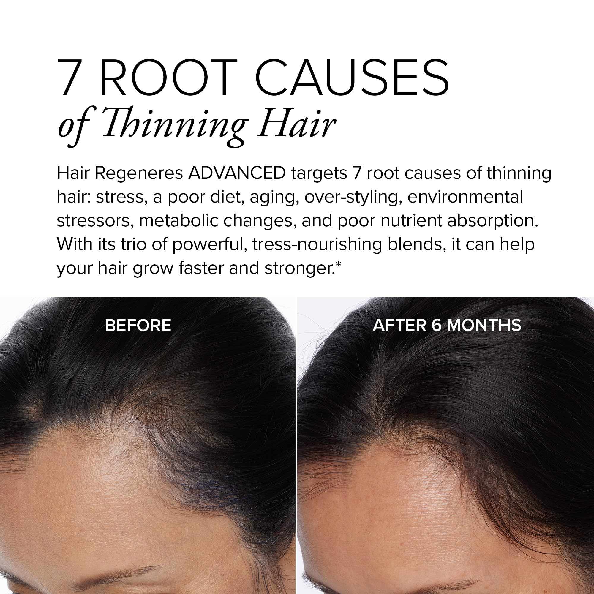 Foto 4 pulgar | Suplemento Serovital Hair Regeneres Advanced 90 Comprimidos - Venta Internacional.