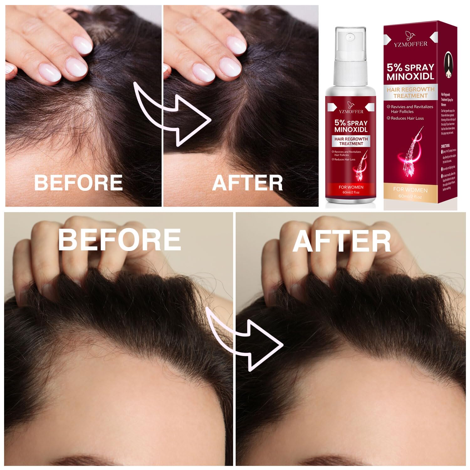 Foto 6 pulgar | Spray Para El Crecimiento Del Cabello Yzmoffer Con 5% De Minoxidil Para Mujeres, 56 Ml - Venta Internacional.