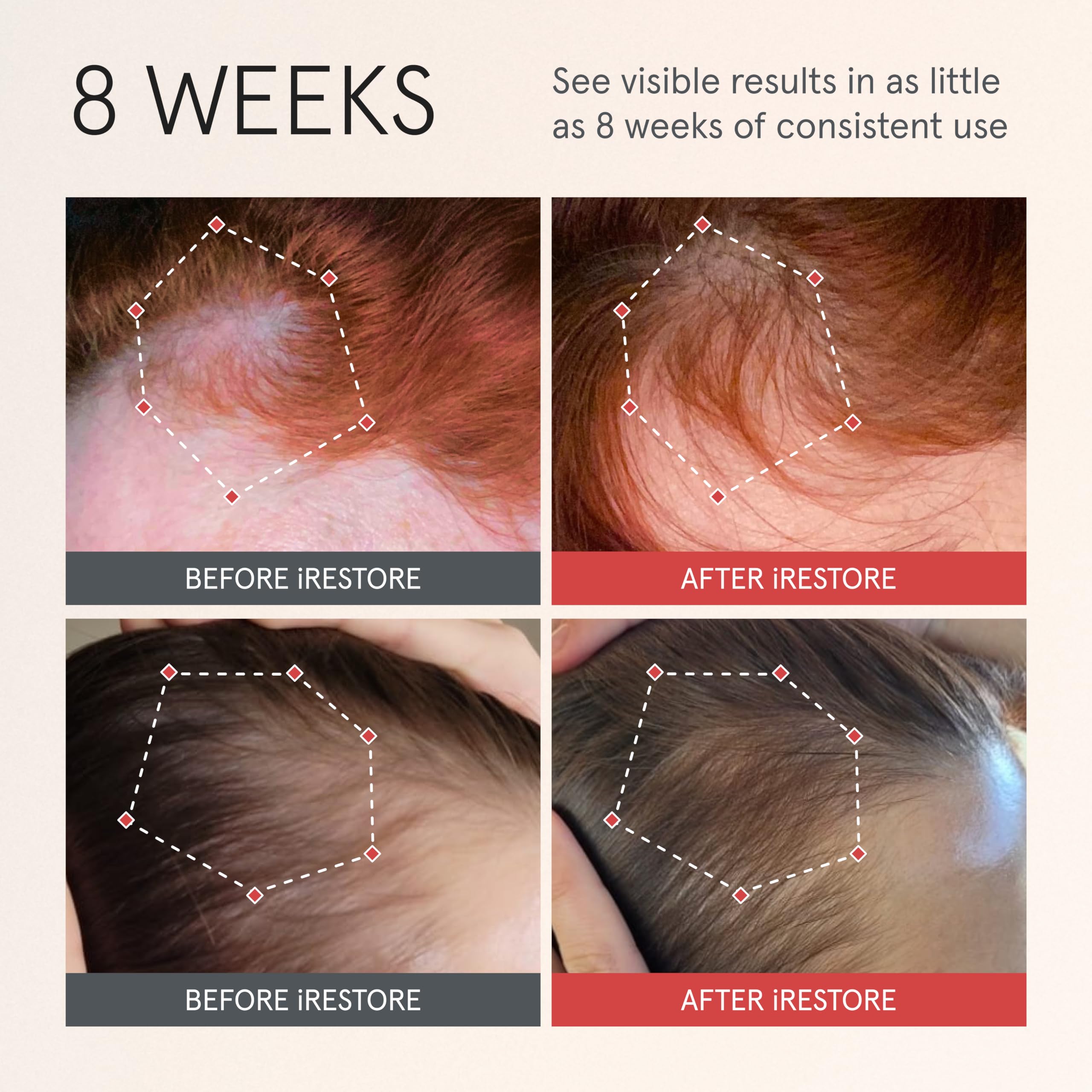 Foto 3 pulgar | Sérum Para El Crecimiento Del Cabello Irestore Scalp Serum 60 Ml Para Mujeres Y Hombres - Venta Internacional.