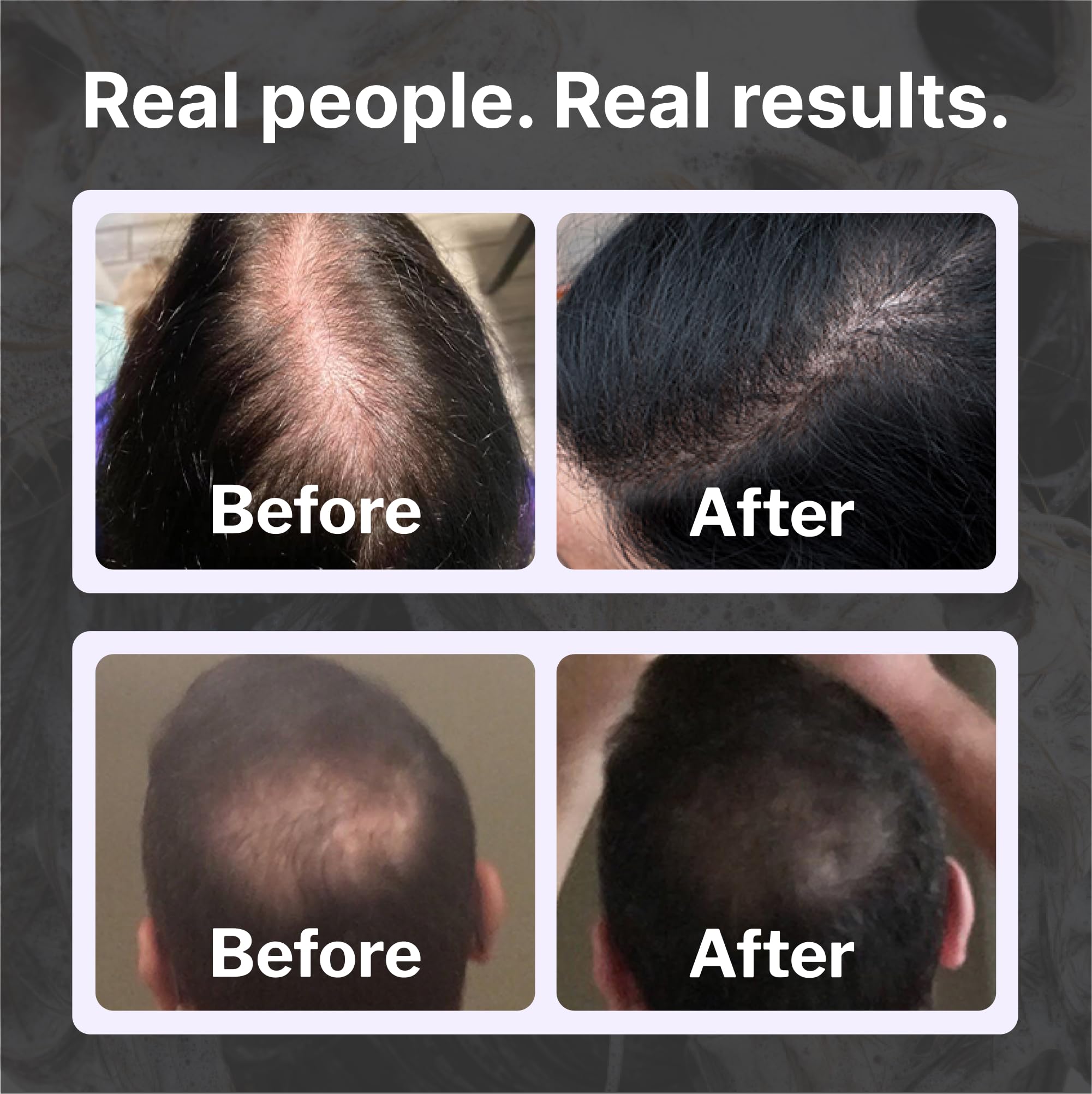 Foto 5 pulgar | Shampoo Shapiro Md Hair Growth Experts Caída Del Cabello Durante 1 Mes - Venta Internacional.