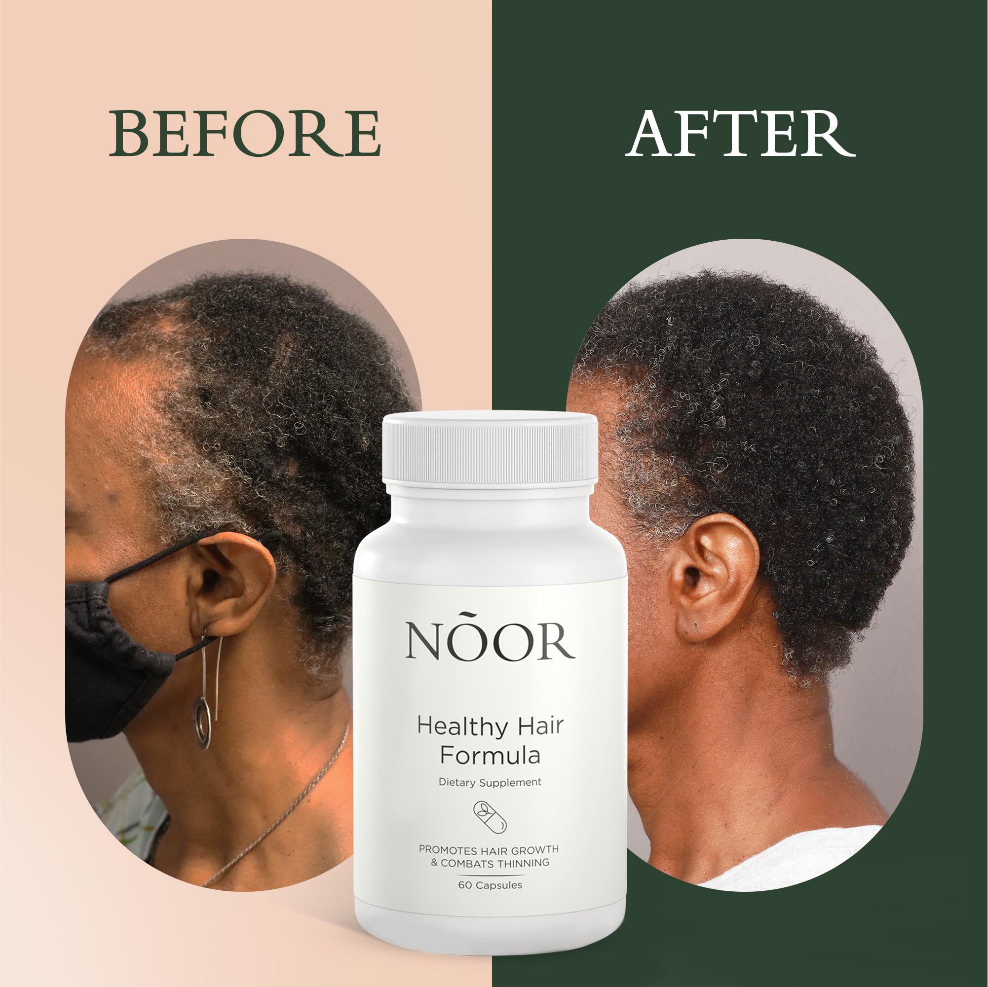 Foto 4 pulgar | Suplemento Para El Crecimiento Del Cabello Noor Hair Healthy Hair, Suministro De 30 Días - Venta Internacional.