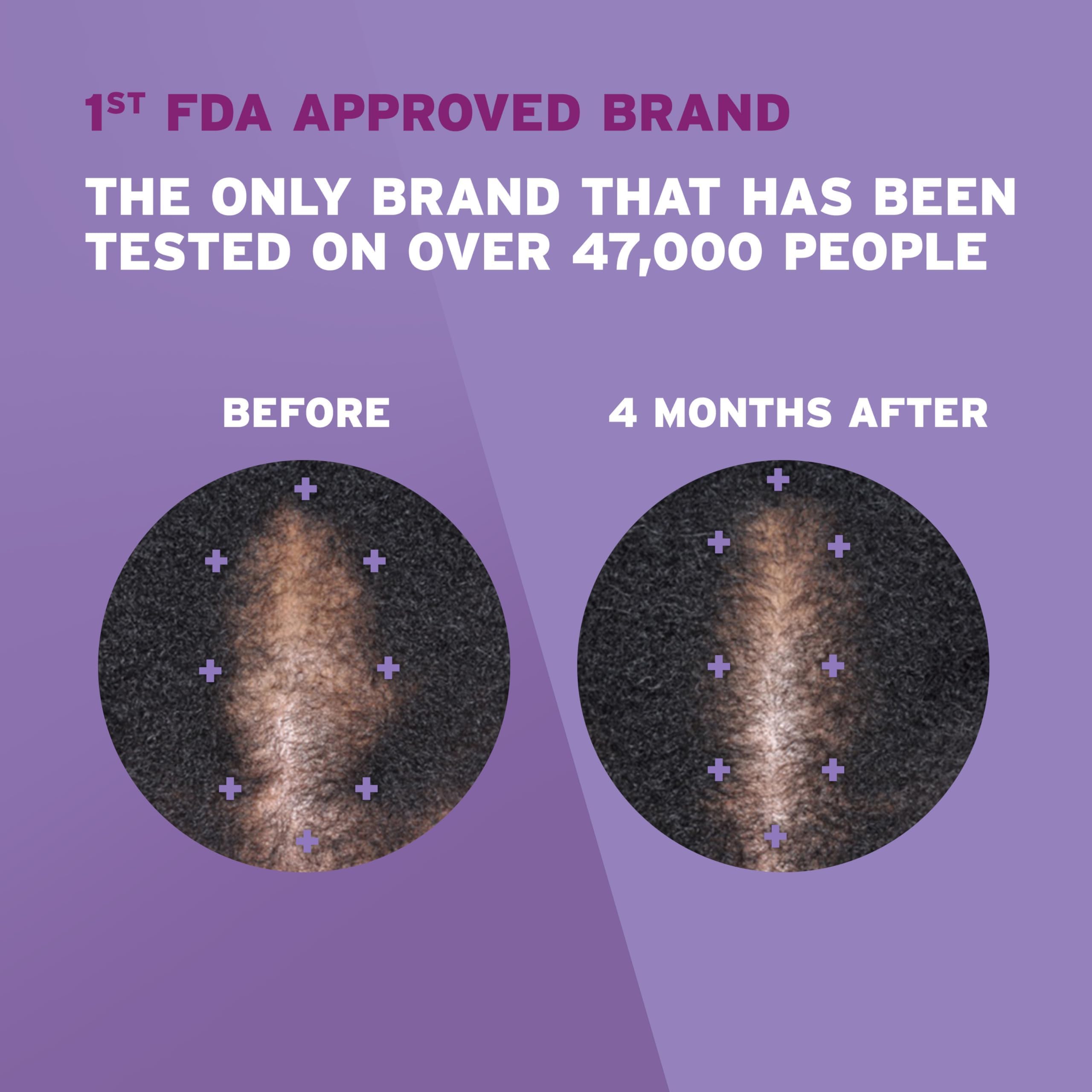 Foto 4 pulgar | Tratamiento De Pérdida De Cabello Rogaine 5% Minoxidil Foam Para Mujeres - Venta Internacional.