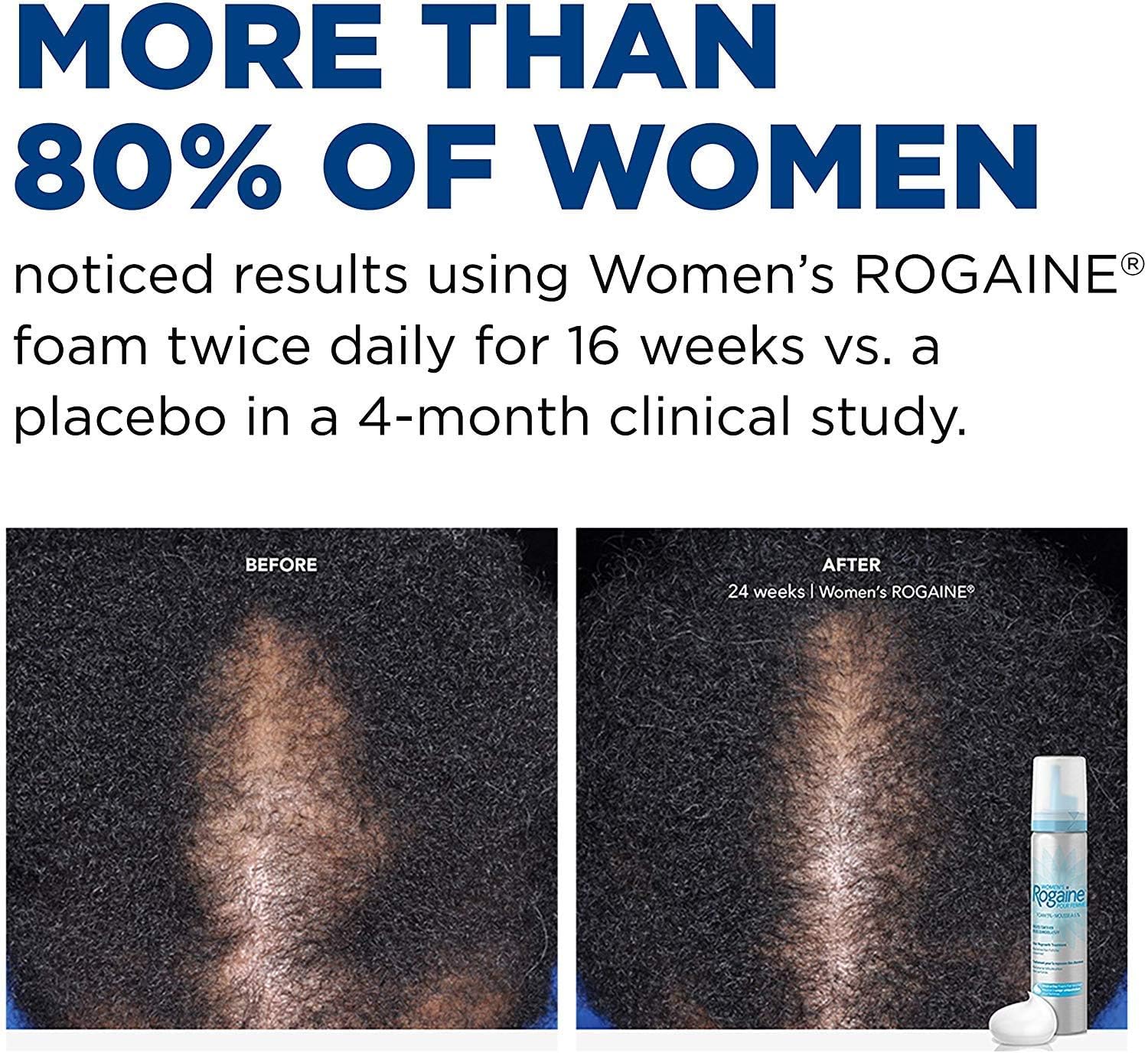 Foto 5 pulgar | Tratamiento De Pérdida De Cabello Rogaine 5% Minoxidil Foam Para Mujeres - Venta Internacional.