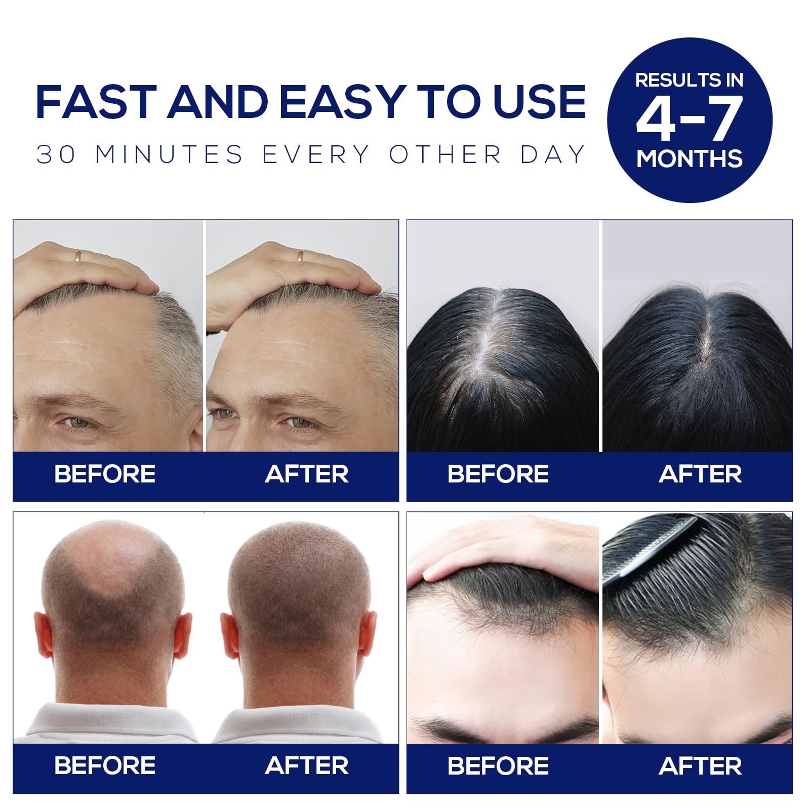 Foto 5 pulgar | Gorro Láser Para El Crecimiento Del Cabello Nnushk, Terapia De Luz Roja Para Cabello - Venta Internacional.