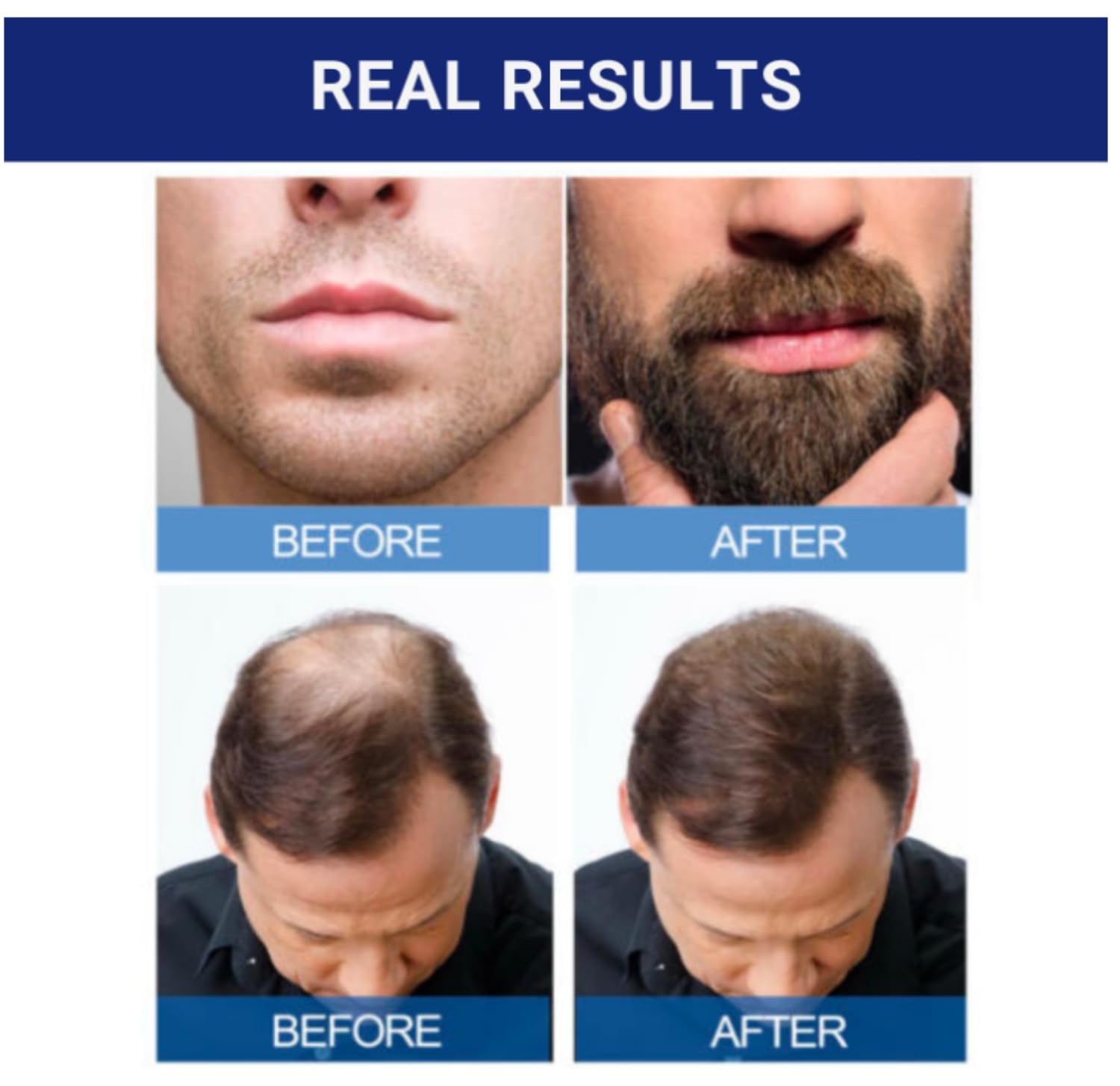 Foto 8 pulgar | Tratamiento Anticaída Kirkland, Suministro De 5% De Minoxidil Para 6 Meses - Venta Internacional.