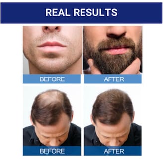 Foto 7 | Tratamiento Anticaída Kirkland, Suministro De 5% De Minoxidil Para 6 Meses - Venta Internacional.