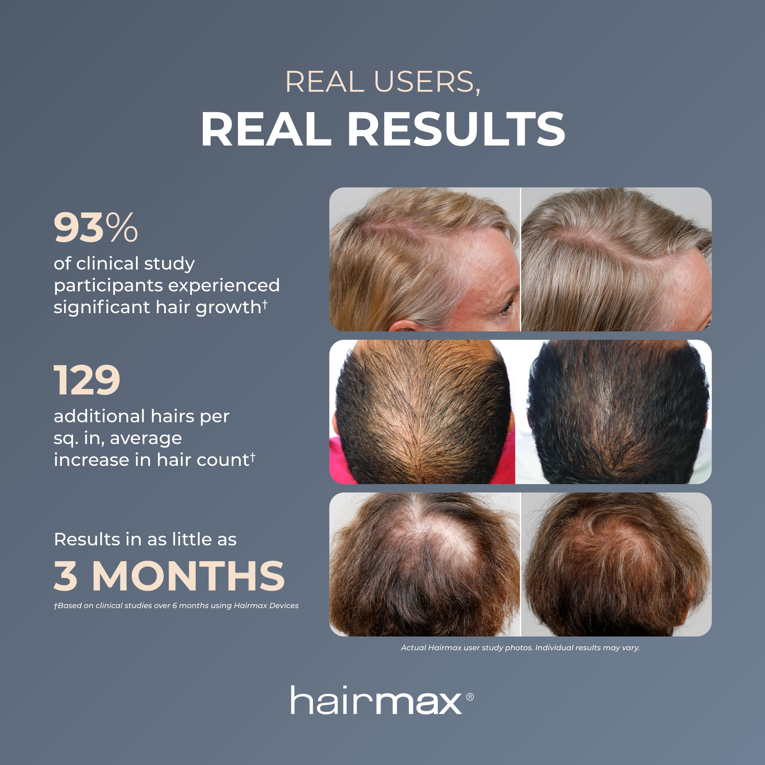 Foto 4 pulgar | Dispositivo Para El Crecimiento Del Cabello Hairmax Laser Band 41 Aprobado Por La Fda - Venta Internacional.