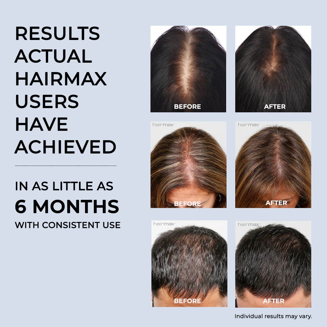 Foto 5 | Dispositivo Para El Crecimiento Del Cabello Hairmax Laser Band 41 Aprobado Por La Fda - Venta Internacional.