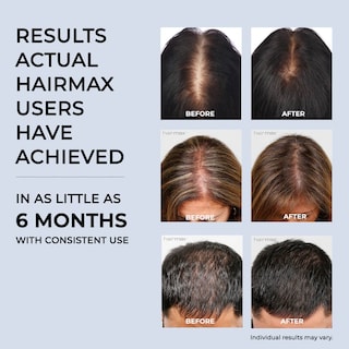 Foto 5 | Dispositivo Para El Crecimiento Del Cabello Hairmax Laser Band 41 Aprobado Por La Fda - Venta Internacional.