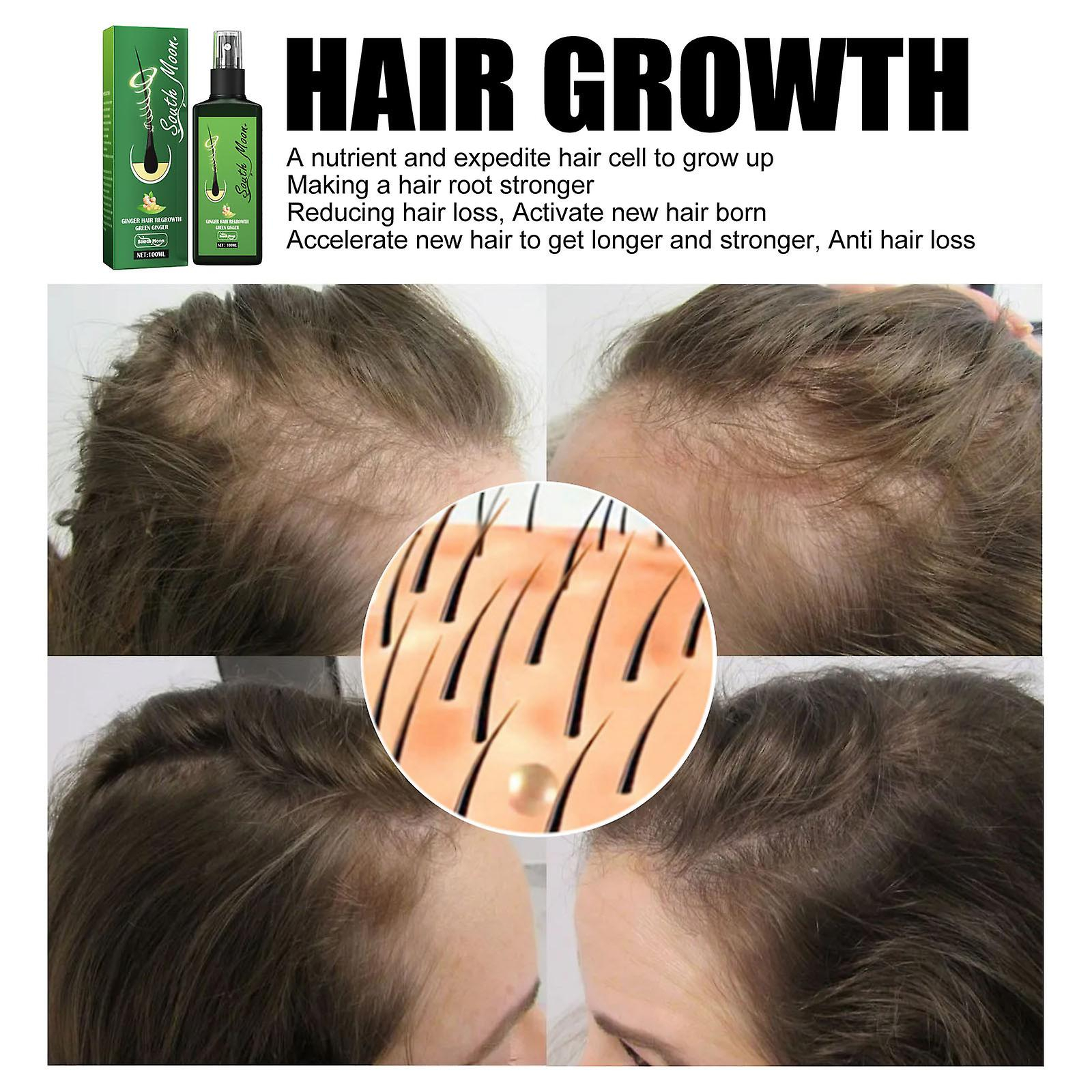 Foto 5 pulgar | Sérum En Aerosol Para Pérdida De Cabello  Adelgazamiento Y Crecimiento Del Cabello  100 Ml X 2 - Venta Internacional.