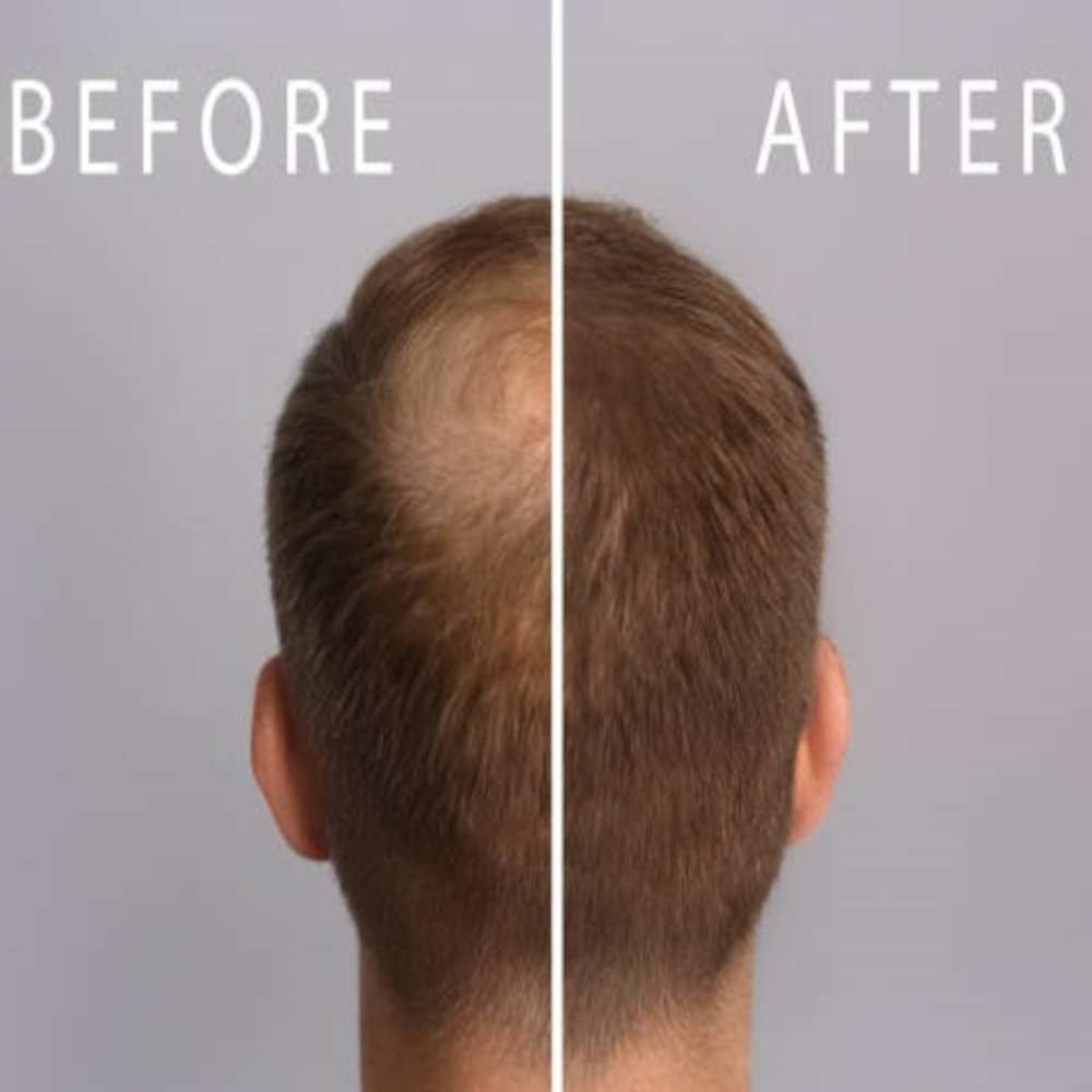 Foto 6 | Shampoo Anticaída Con Minoxidil Y Biotina Allskin