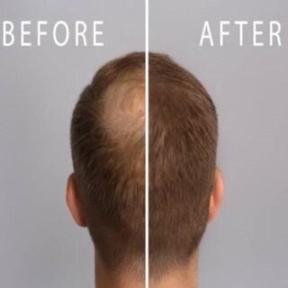 Foto 6 | Shampoo Anticaída Con Minoxidil Y Biotina Allskin
