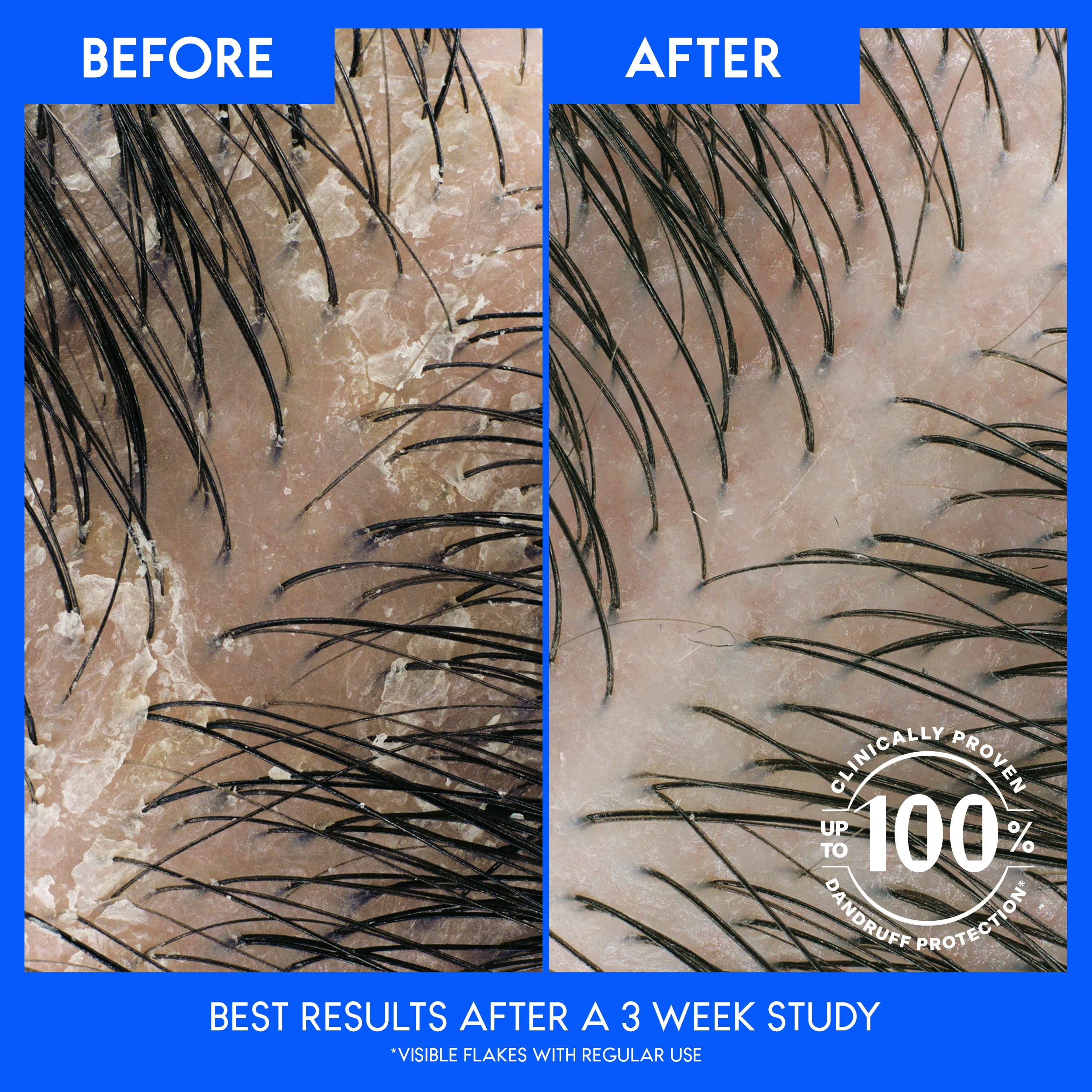 Foto 4 pulgar | Champú Head & Shoulders Itchy Scalp Care Anticaspa 950 Ml X2 - Venta Internacional.