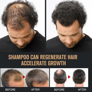 Foto 4 | Champú Root Activator Para El Crecimiento Del Cabello Y Anticaída, 2 Unidades - Venta Internacional.