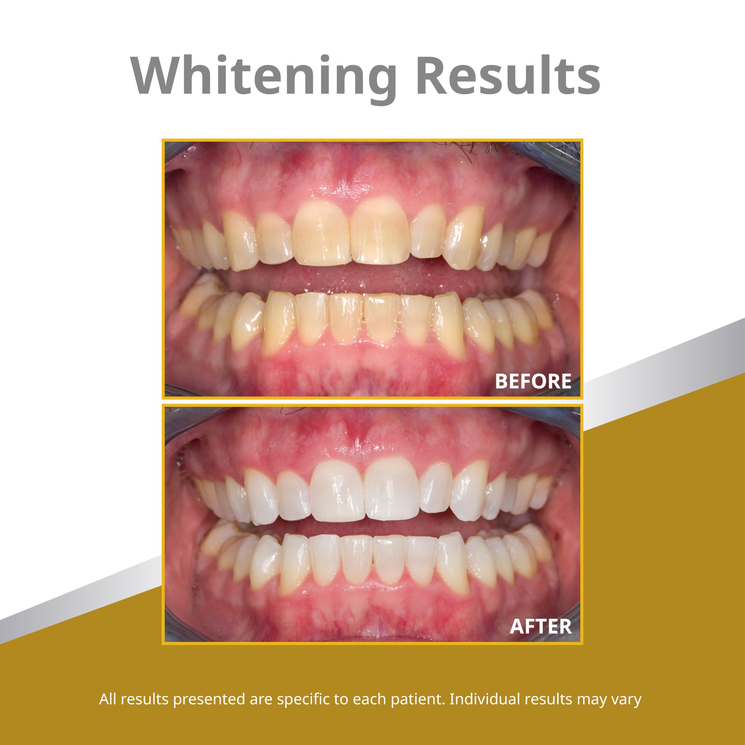 Foto 6 pulgar | Jeringas De Gel Blanqueadoras De Dientes Opalescence Quick Pf 45% (12) - Venta Internacional.