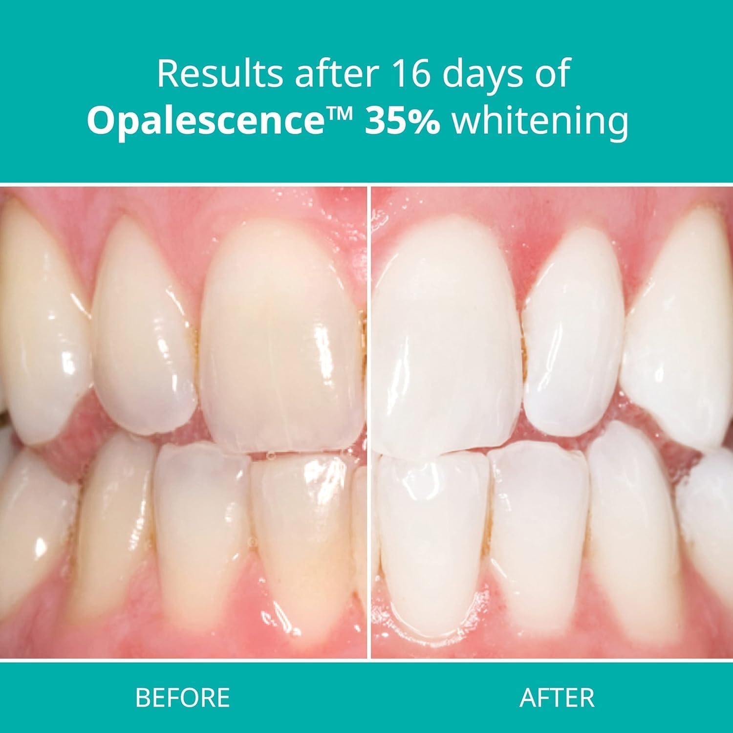 Foto 3 pulgar | Kit De Recambio Para Blanqueamiento Dental Opalescence 35% Pf  4 Jeringas - Venta Internacional.